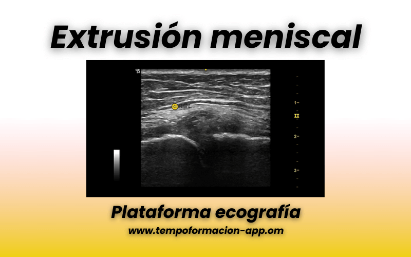 6. Menisco interno tempo formacion.png